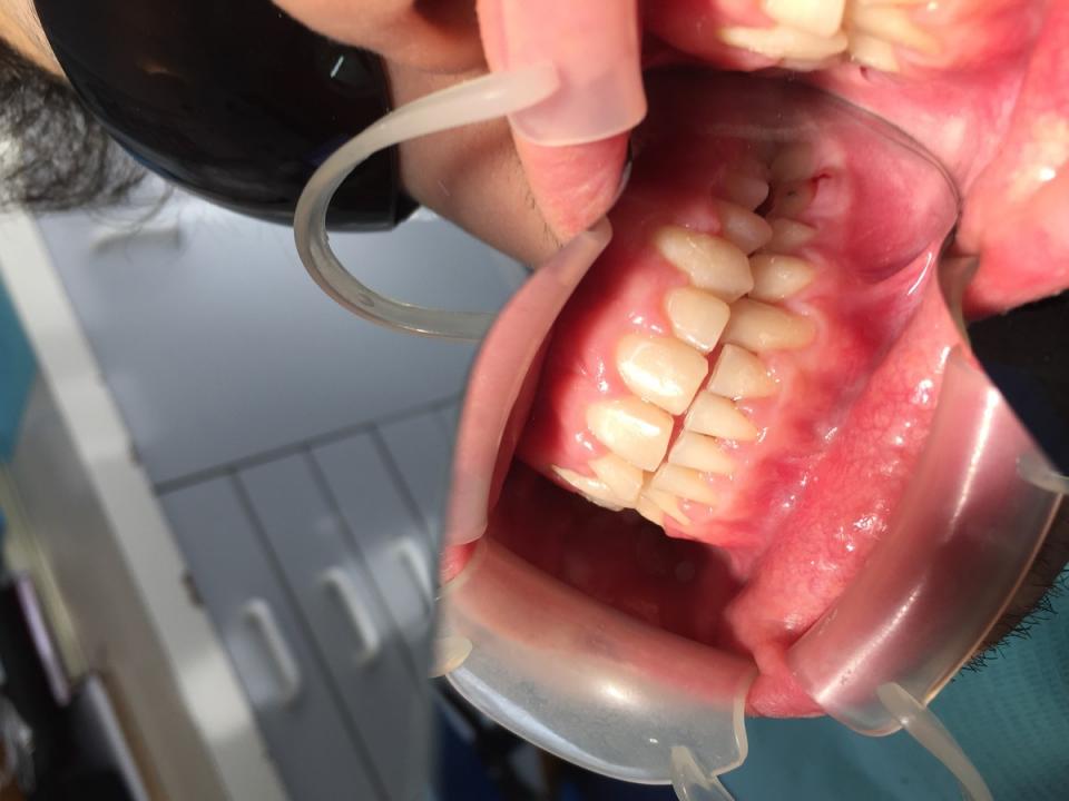 Fastbraces® | Capital Dental
