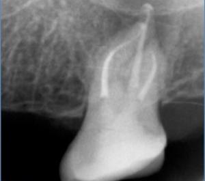 X-ray of a tooth