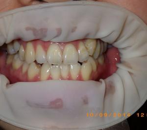 Fastbraces Before