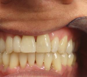 Fastbraces After