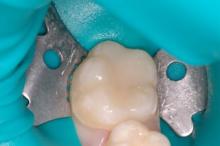 Fissure sealants