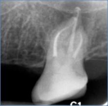 X-ray of a tooth 